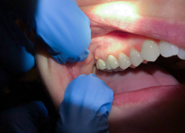 Best Emergency Tooth Extraction  in Golden Gate, FL