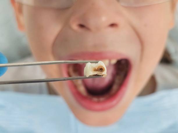 Best Cracked Tooth Emergency Dentist  in Golden Gate, FL